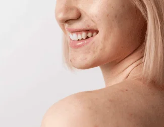 Acne before