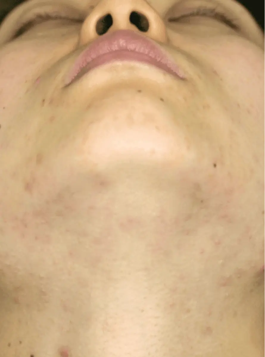 After-Jowl-Acne-Treatment