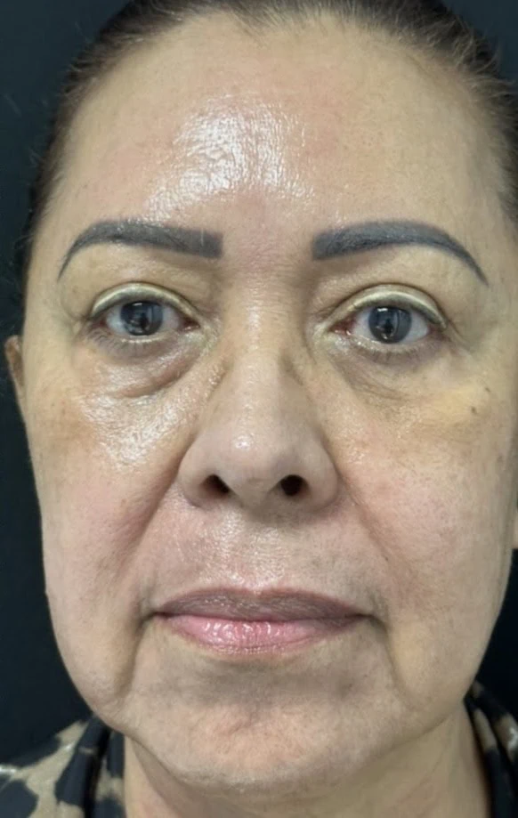 After Laser Resurfacing