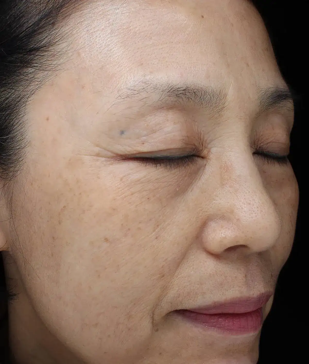 After Wrinkles Treatment