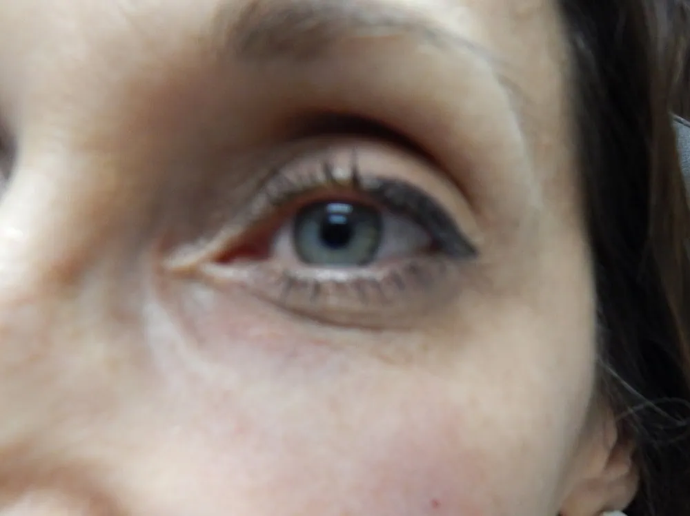 Before Dark circle eyes