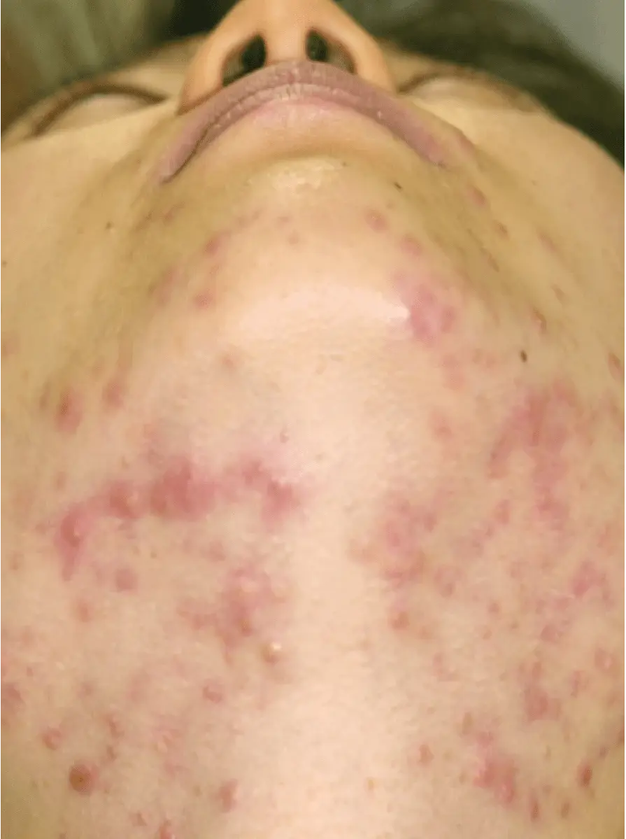 Before-Jowl-Acne-Treatment