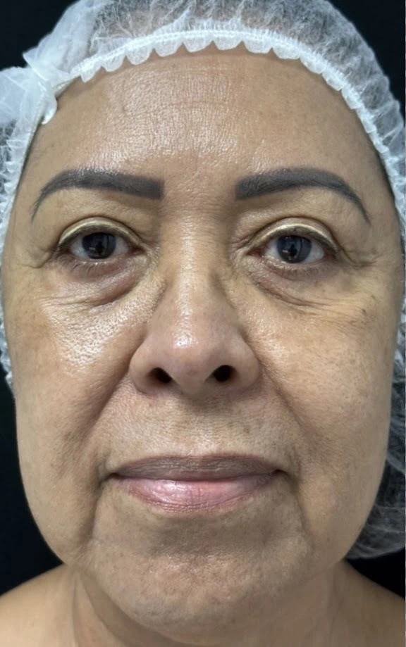 Before Laser Resurfacing