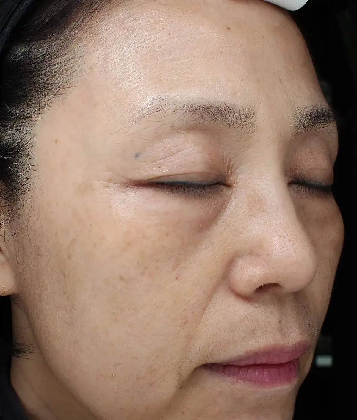 Before Wrinkles Treatment