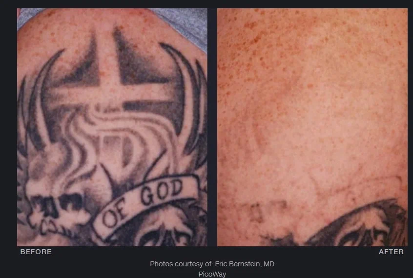Before and After Tattoo Removal a