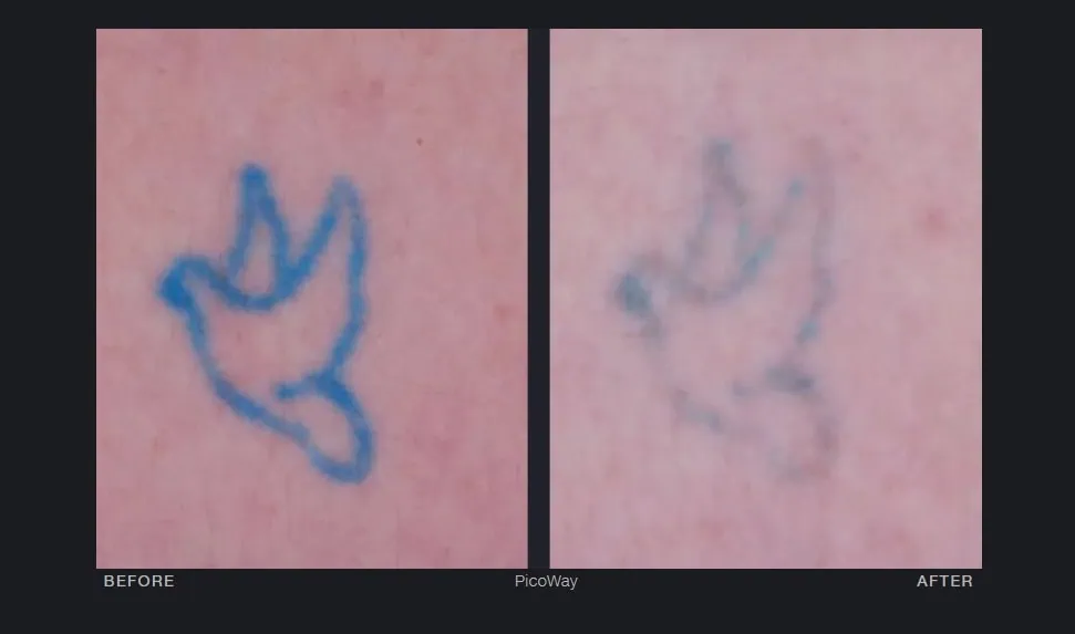 Before and After Tattoo Removal