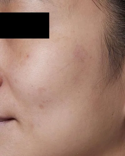 Dark spots after
