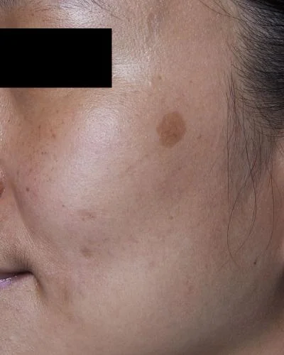 Dark spots before