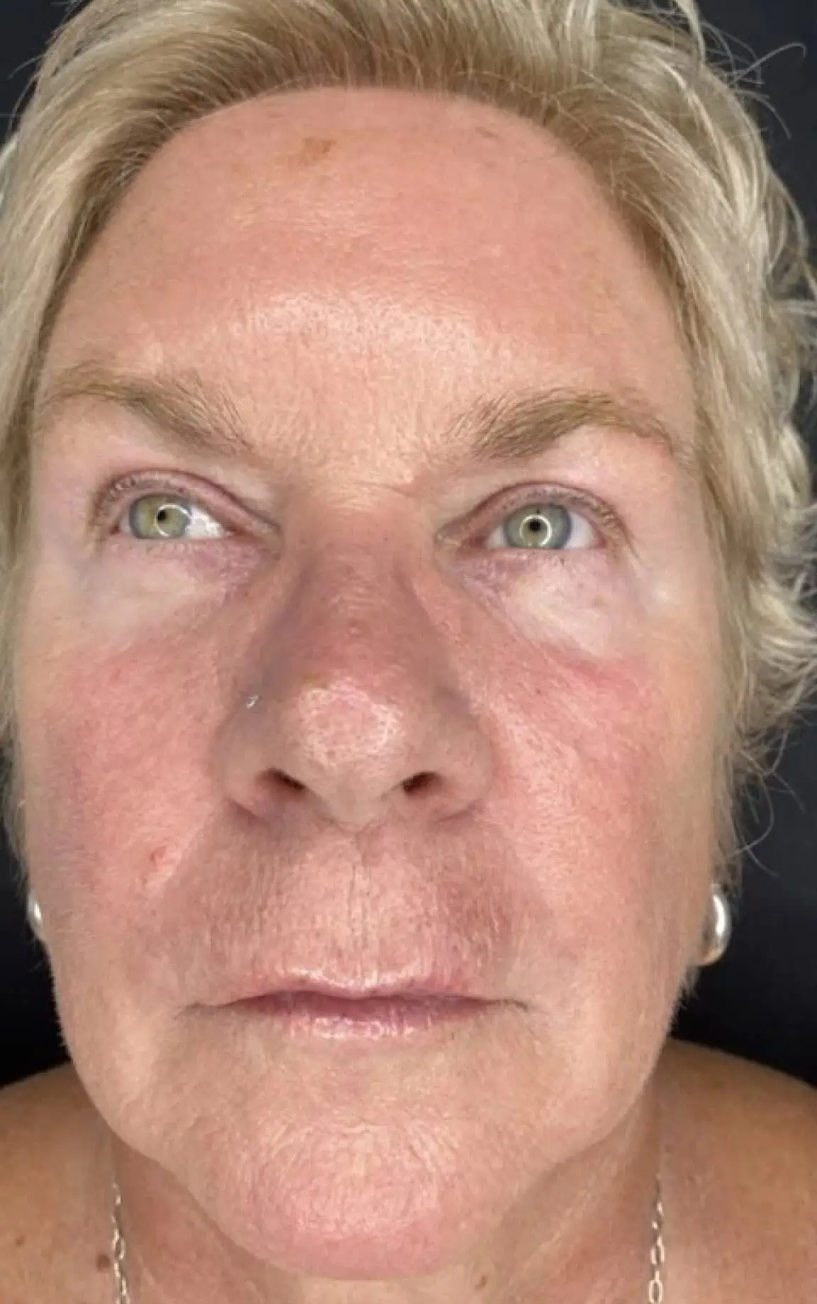 Skin After a
