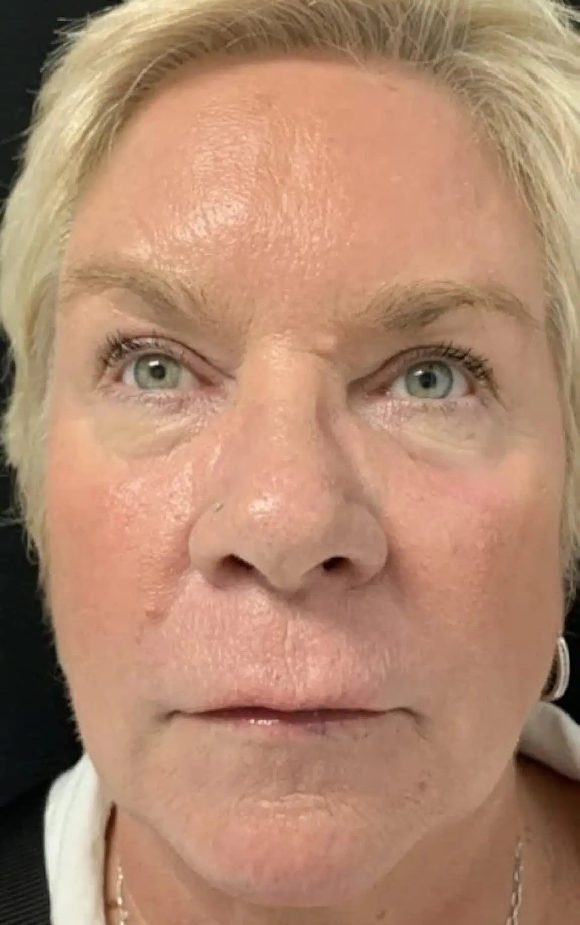 Skin before a