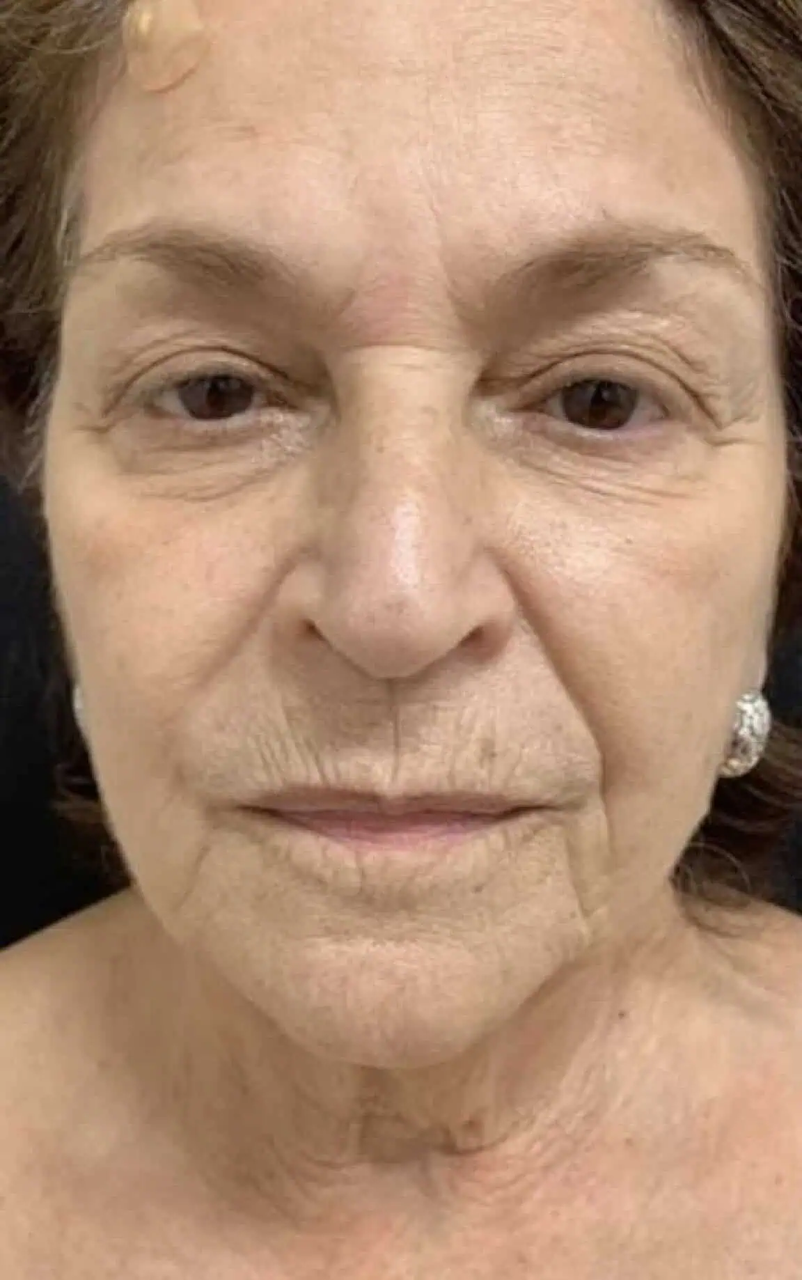 Skin before b