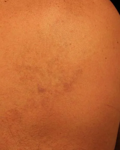 Tattoremove after