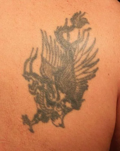 Tattoremove 'before