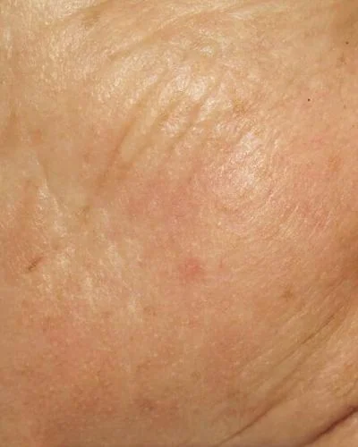 Wrinkles after