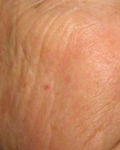 Wrinkles before