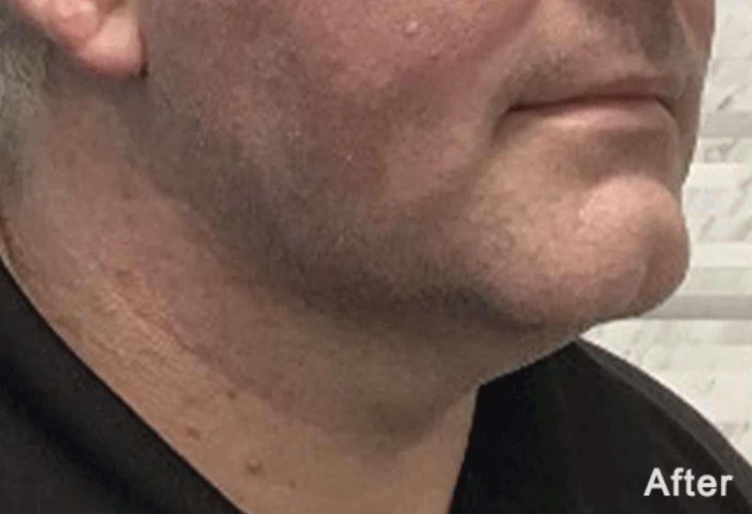hombre-after-morpheus8