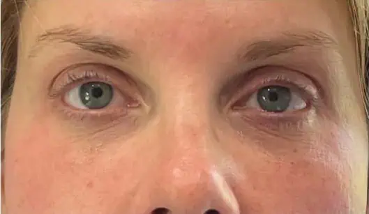 After Saltfacial
