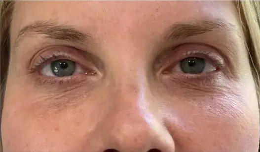 Before Saltfacial
