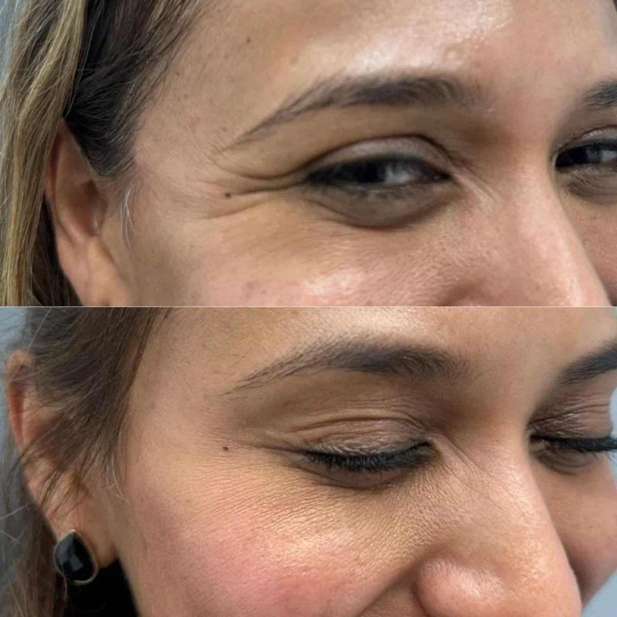 Before and After Botox Treatment a