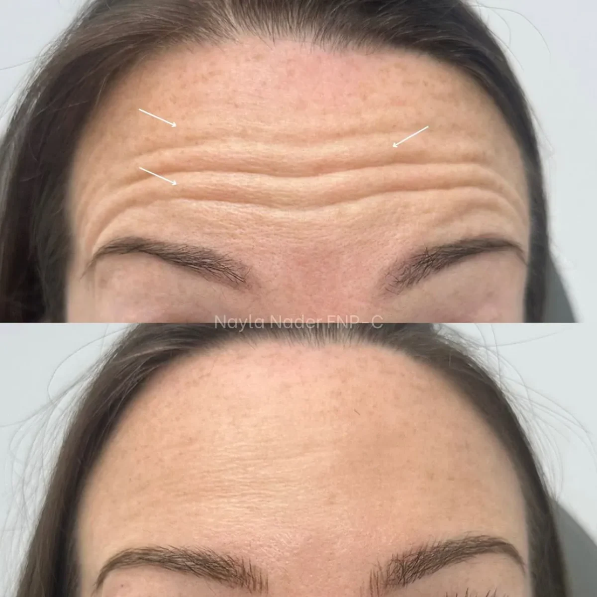 Before and After Botox Treatment b