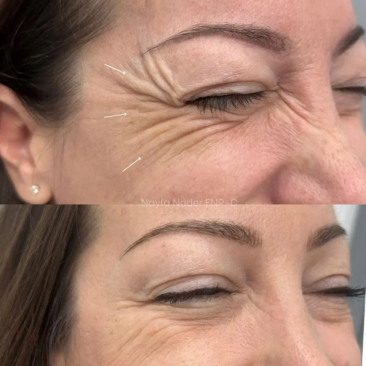 Before and After Botox Treatment
