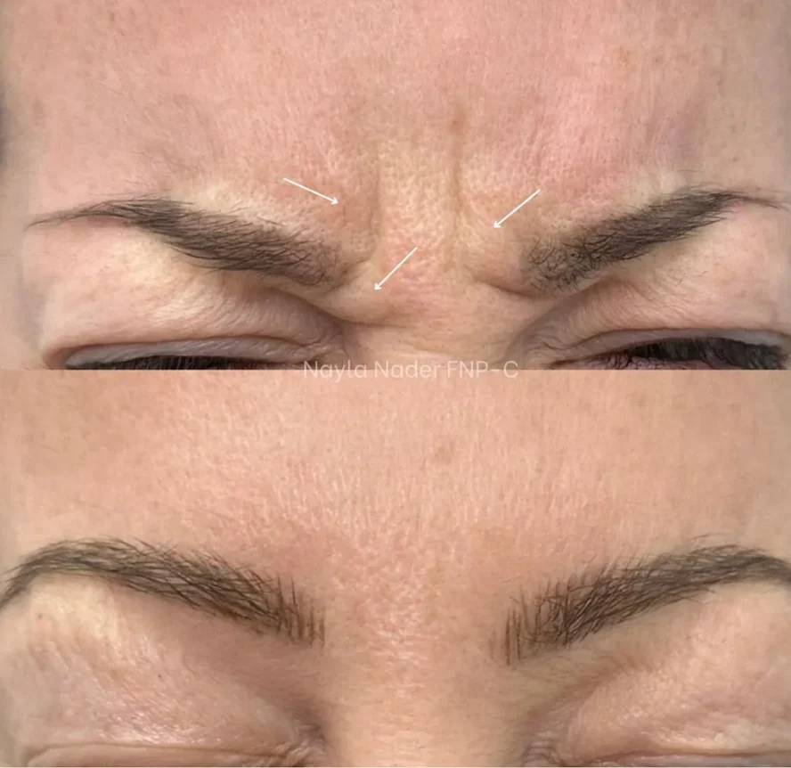 Before and After Botox a