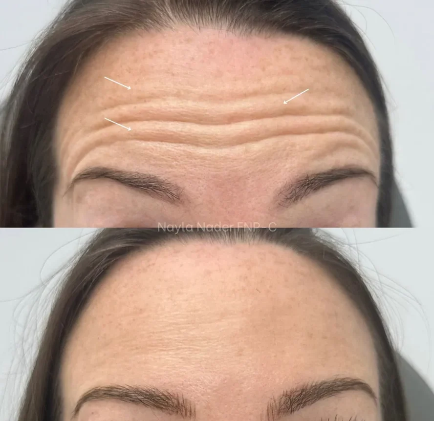 Before and After Botox b