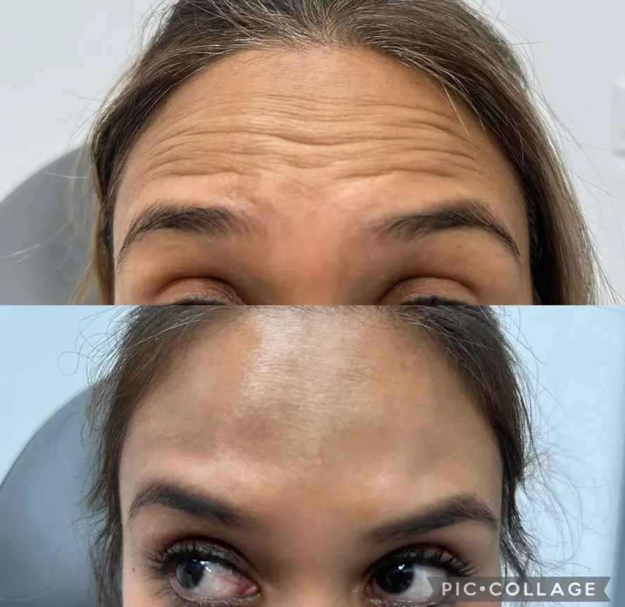Before and After Botox c
