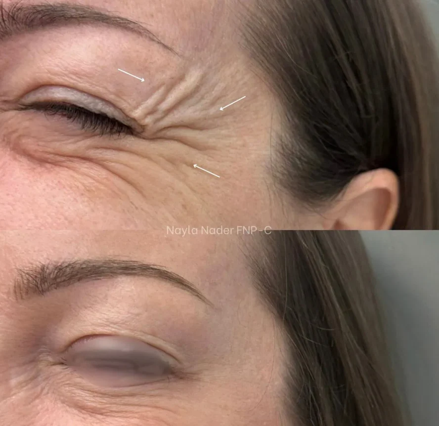 Before and After Botox d