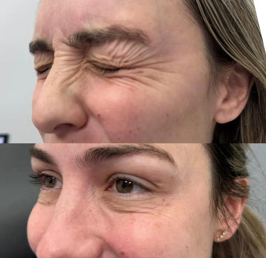 Before and After Botox e