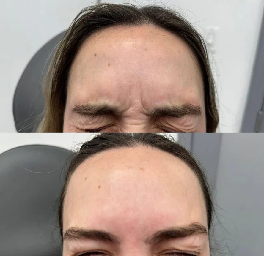 Before and After Botox f