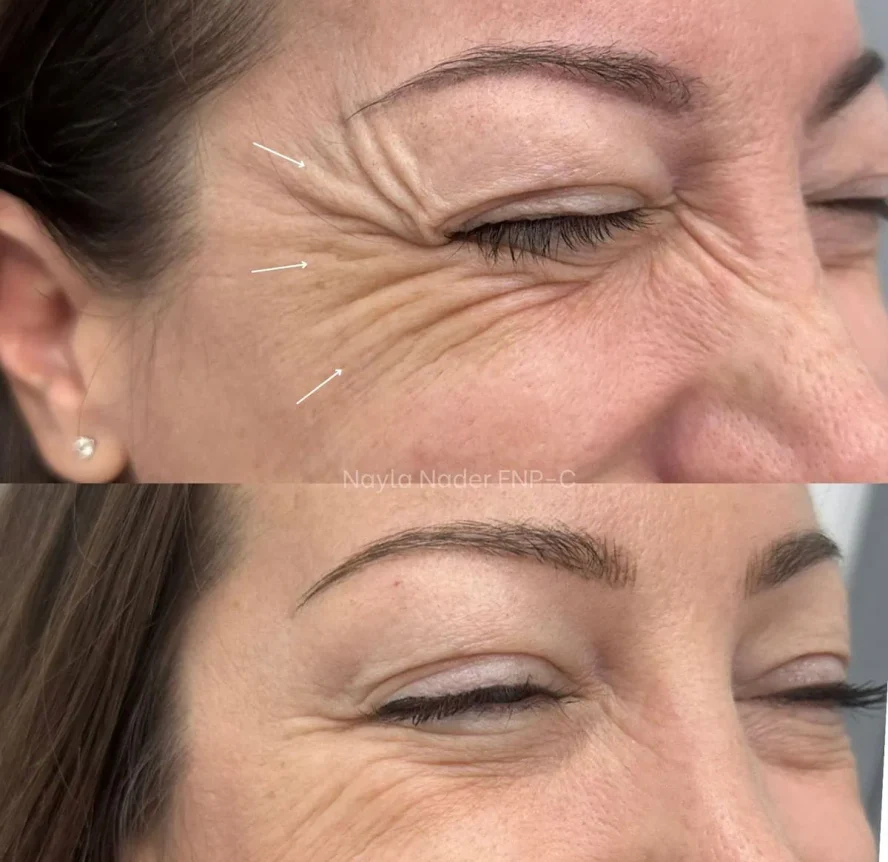 Before and After Botox j