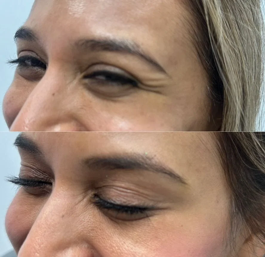Before and After Botox k