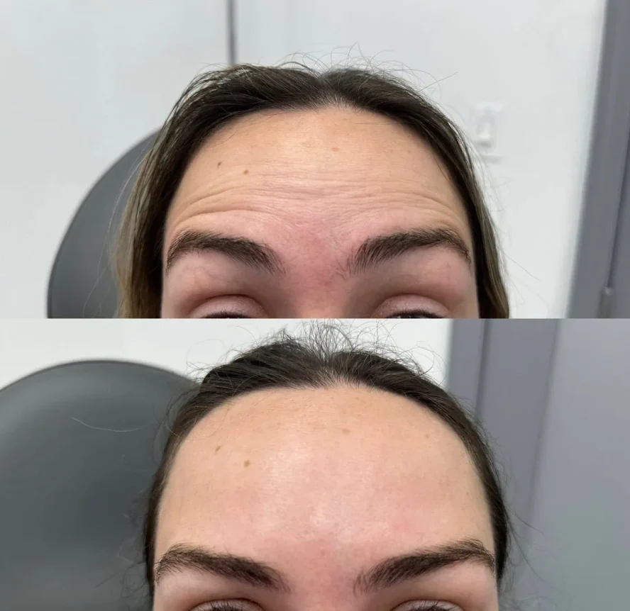 Before and After Botox