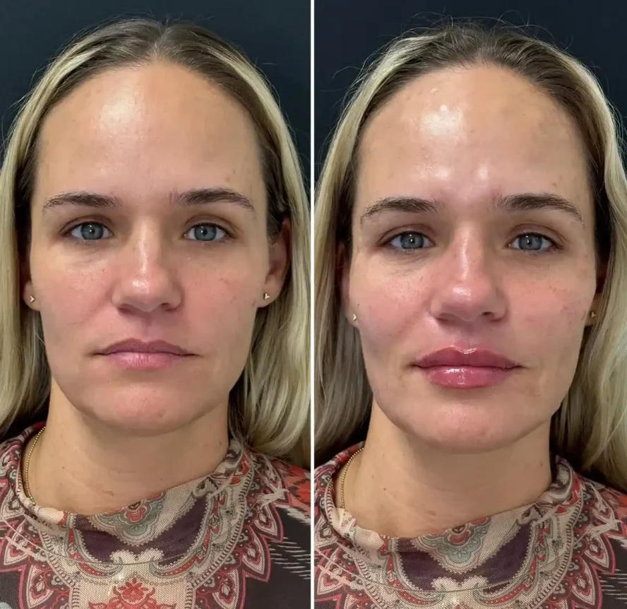 Before and After Under-Eye Filler