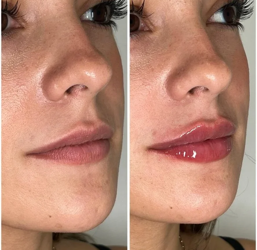 Before and After Lip Filler Treatment a