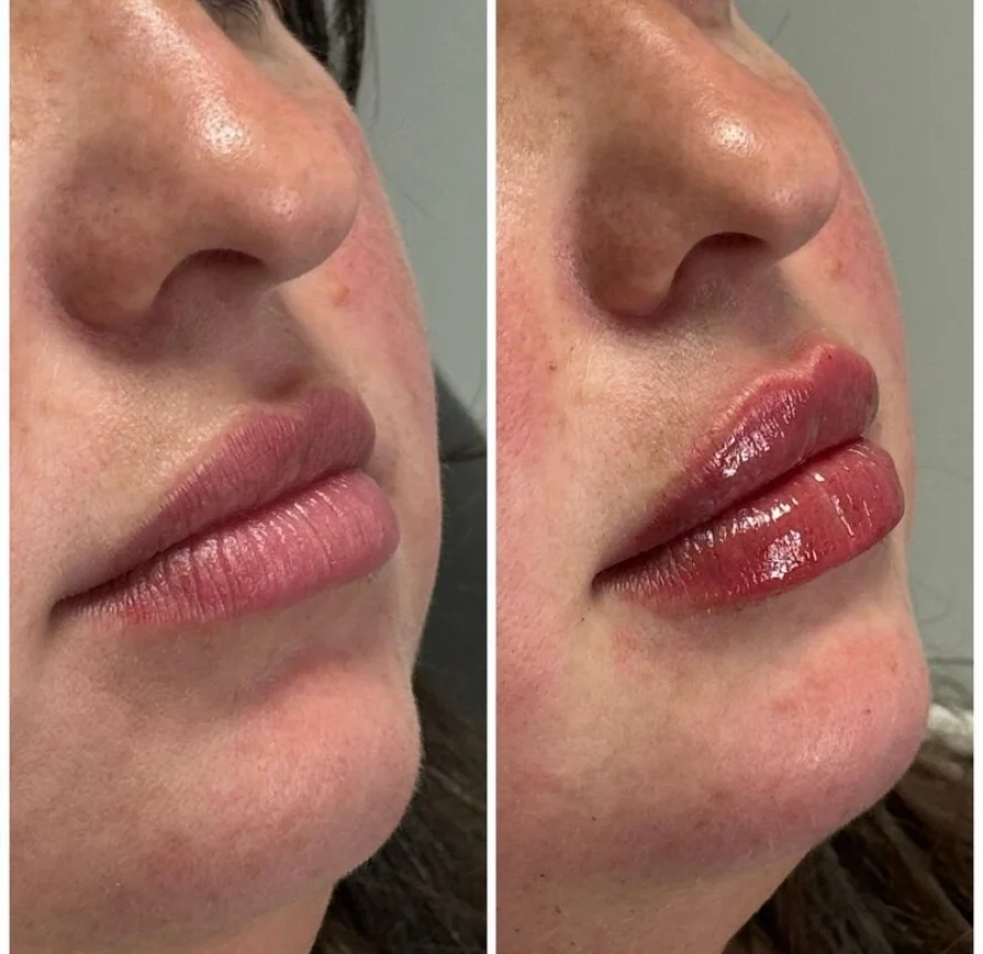 Before and After Lip Filler Treatment b
