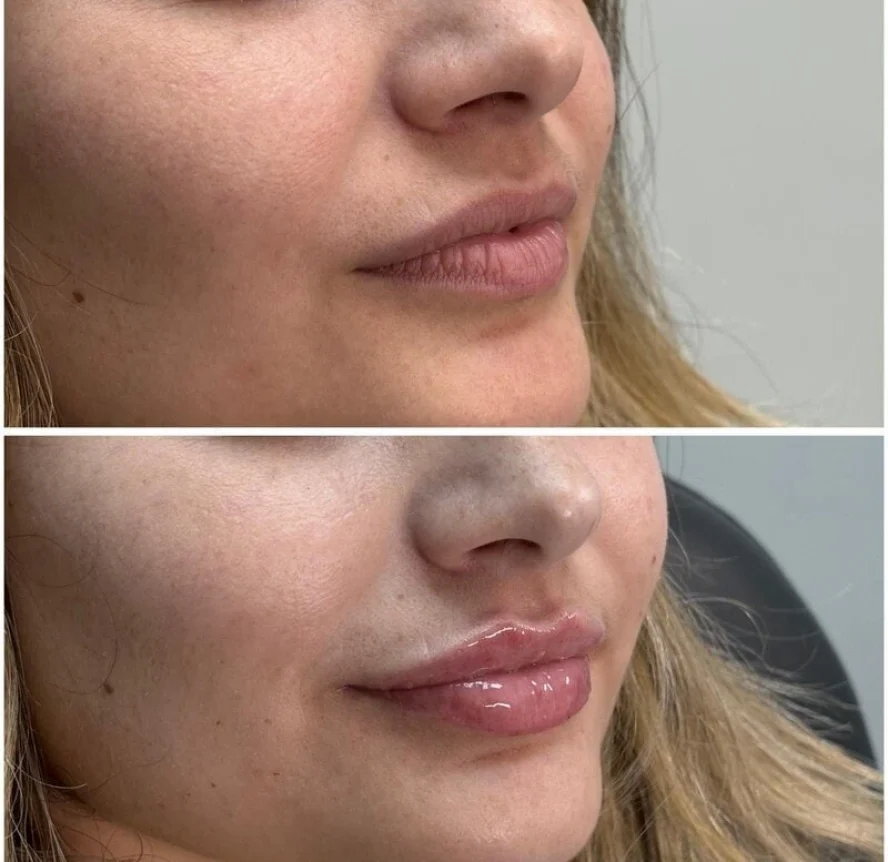 Before and After Lip Filler Treatment c