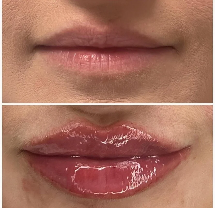 Before and After Lip Filler Treatment d
