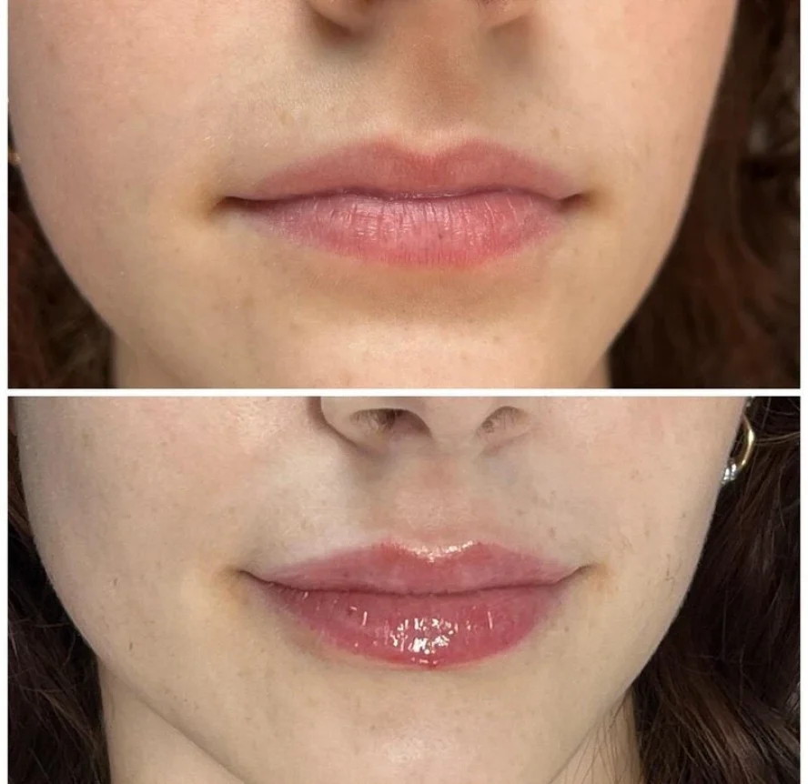 Before and After Lip Filler Treatment e