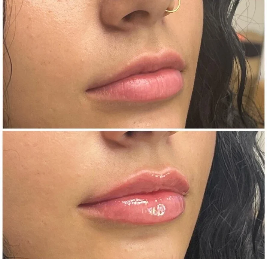 Before and After Lip Filler Treatment f