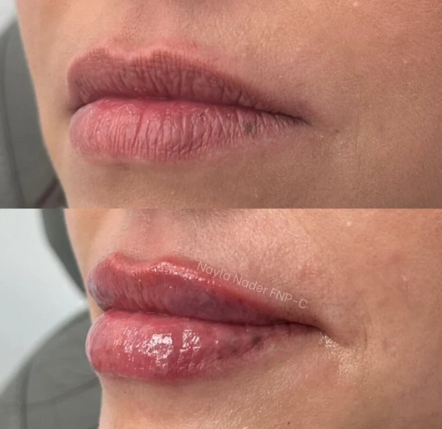 Before-and-After-Lip-Filler-Treatment-g