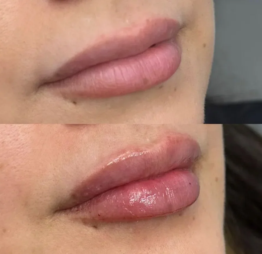 Before-and-After-Lip-Filler-Treatment-h