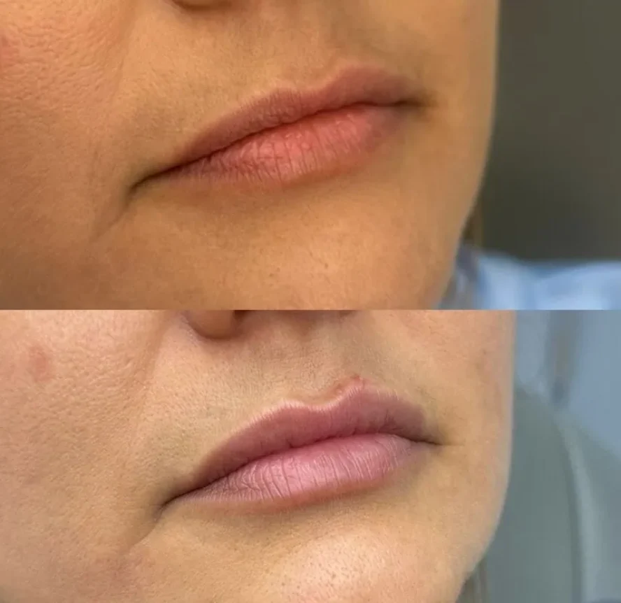 Before-and-After-Lip-Filler-Treatment-i