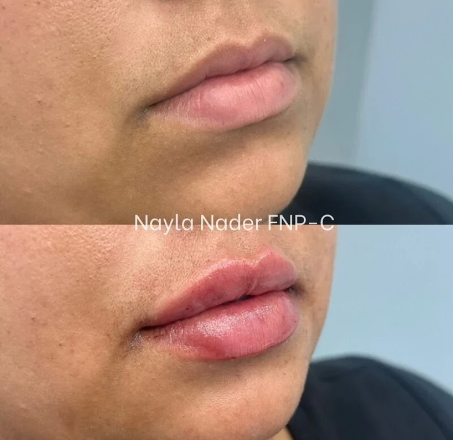 Before-and-After-Lip-Filler-Treatment-j
