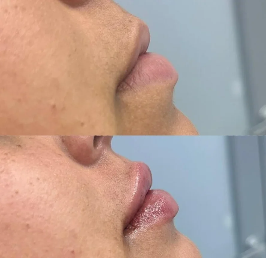 Before-and-After-Lip-Filler-Treatment-k