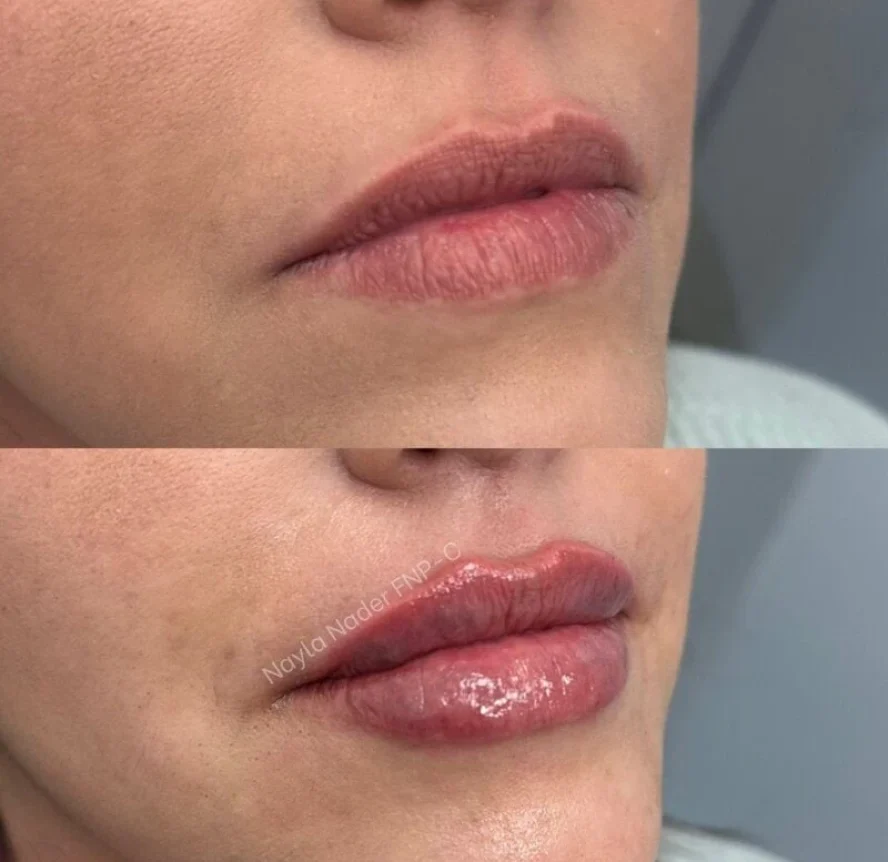 Before-and-After-Lip-Filler-Treatment-l