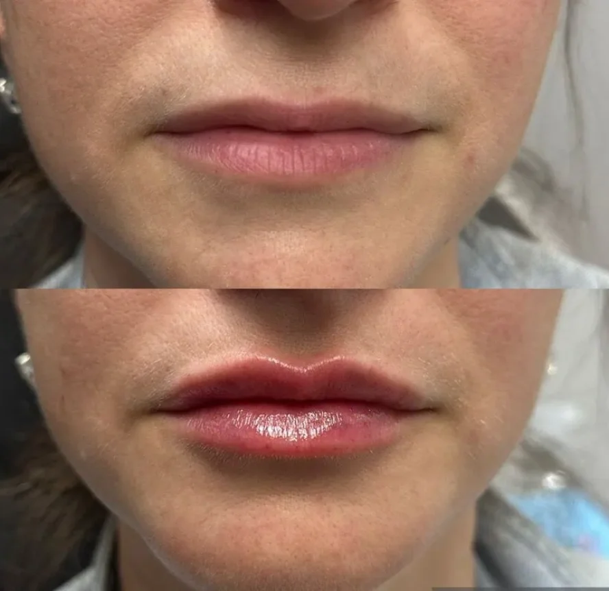 Before-and-After-Lip-Filler-Treatment-m