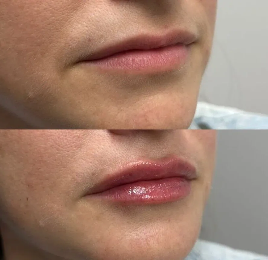 Before-and-After-Lip-Filler-Treatment-n