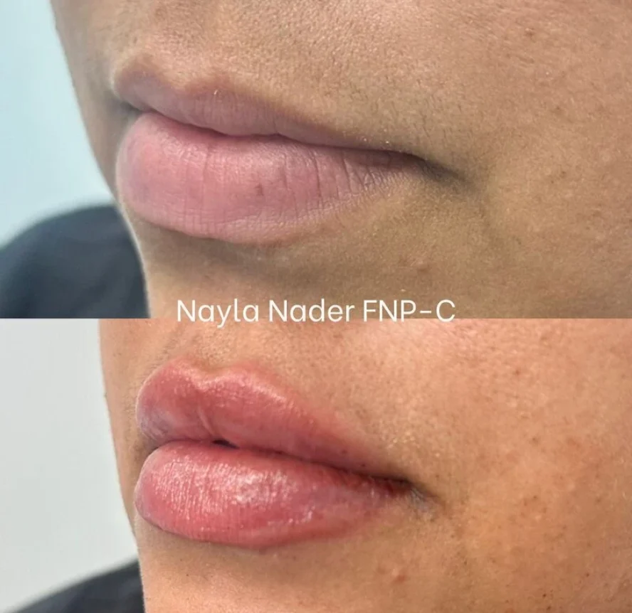 Before-and-After-Lip-Filler-Treatment-o